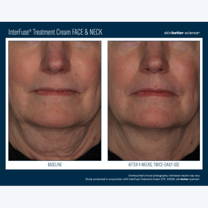Skinbetter Science InterFuse Treatment Cream FACE & NECK