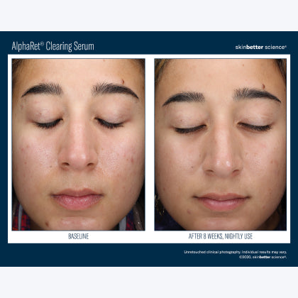Skinbetter Science AlphaRet Clearing Serum