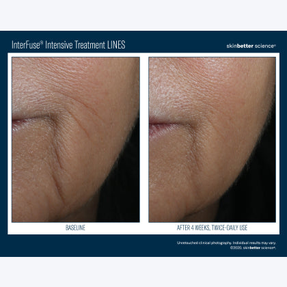Skinbetter Science InterFuse Intensive Treatment LINES